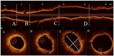 Acute Mechanical Performance of Magmaris vs. DESolve Bioresorbable Scaffolds in a Real-World Scenario